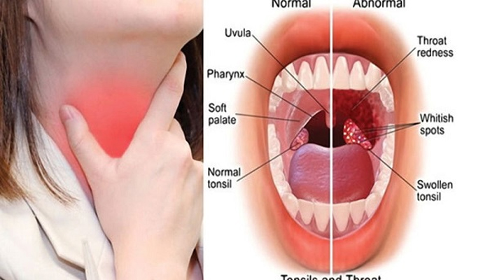 টনসিল কী? লক্ষণ ও চিকিৎসা পদ্ধতি